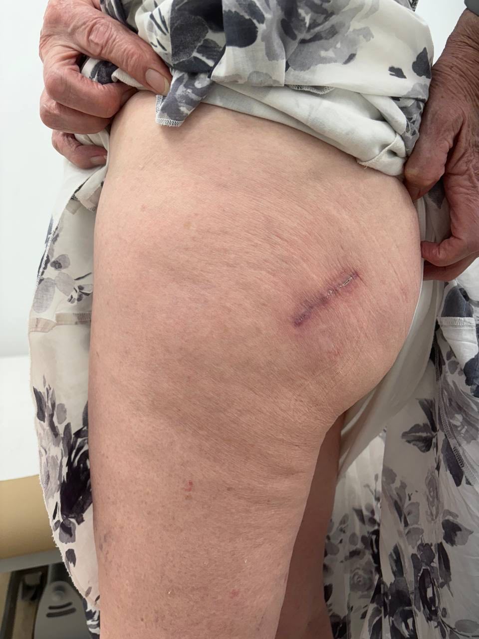 Healed incision after a minimally invasive hip replacement approach